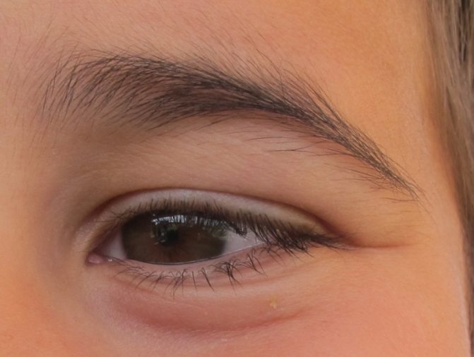 Брови растут в разные стороны