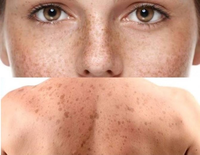 Как выглядит пигментация