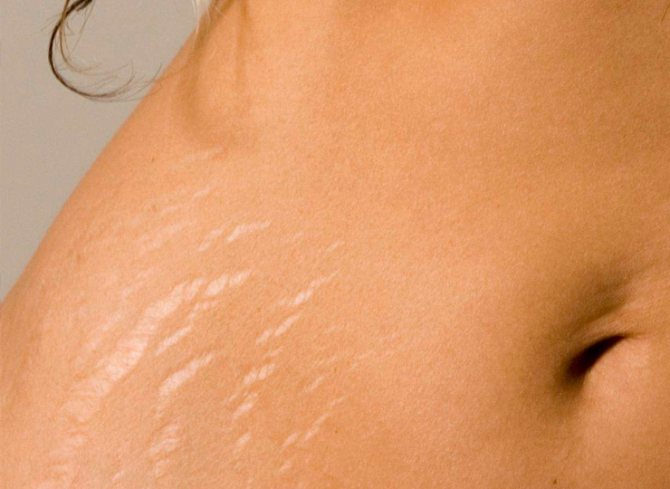 Почему появляются растяжки на коже