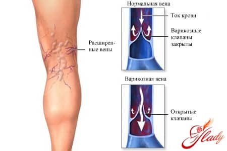 Схема варикоза