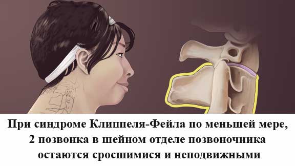 Шея при синдроме Клиппеля-Фейла сращение шейных позвонков