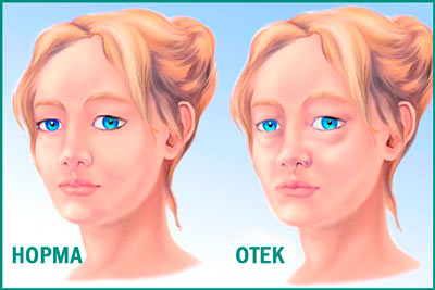 Почечные отеки: симптомы и лечение Почечные отеки: чем снимать отеки