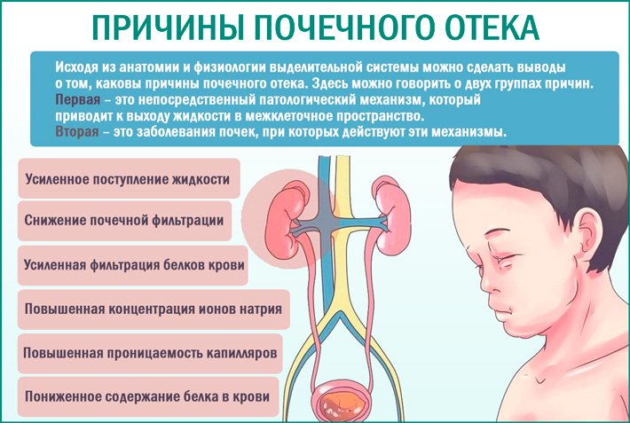 Причины почечного отека Почечные отеки. Причины