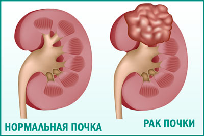 Рак почки Рак почек: симптомы