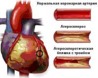 Острый коронарный синдром Острый коронарный синдром
