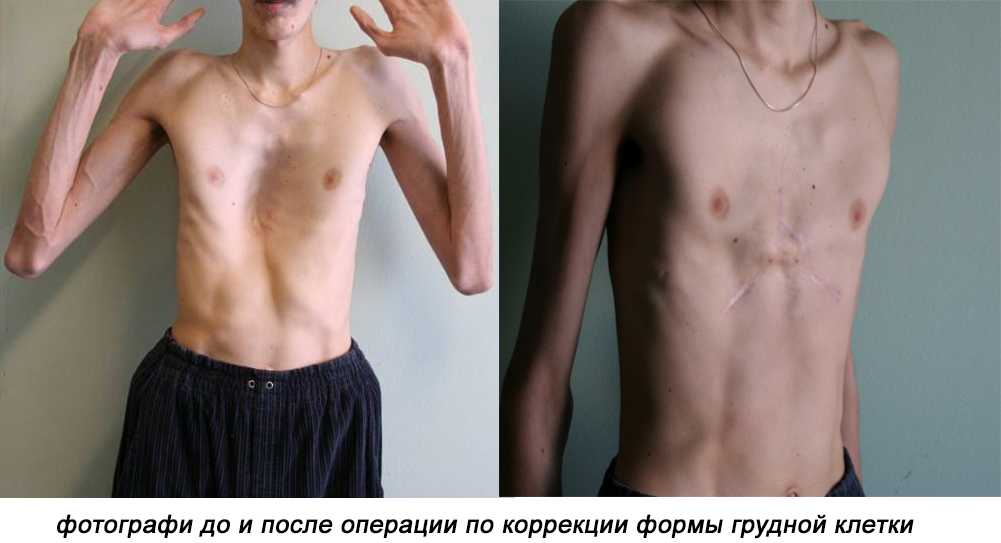 фотографи до и после операции по коррекции формы грудной клетки фотографи до и после операции по коррекции формы грудной клетки