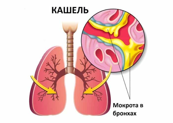 Главный симптом хронического бронхита - периодический или постоянный кашель Главный симптом трахеобронхита - периодический или постоянный кашель