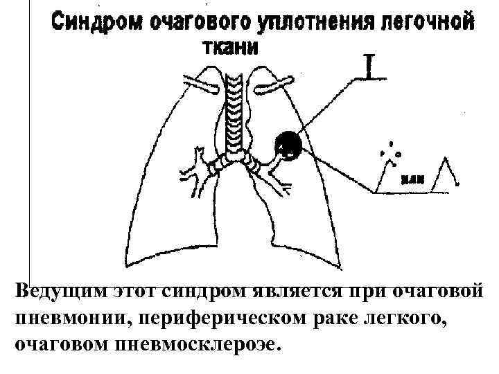 Ведущим этот синдром является при очаговой пневмонии, периферическом раке легкого, очаговом пневмосклероэе. Ведущим этот синдром является при очаговой пневмонии, периферическом раке легкого, очаговом пневмосклероэе.