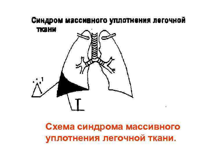 Схема синдрома массивного уплотнения легочной ткани. Схема синдрома массивного уплотнения легочной ткани.