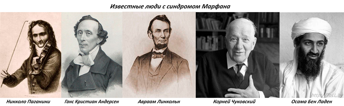 Известные люди с синдромом Марфана Известные люди с синдромом Марфана