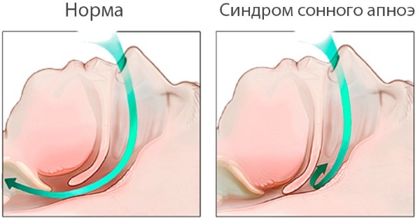 Синдром Тричера Коллинза. Фото до и после операции, причины, лечение
