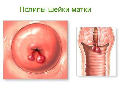 Полипы шейки матки