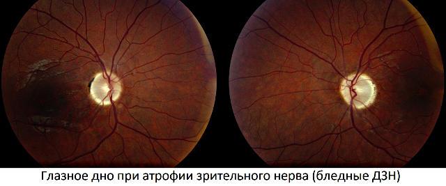 Причины и симптомы атрофии зрительного нерва глаза (ЧАЗН) Причины и симптомы атрофии зрительного нерва глаза (ЧАЗН)