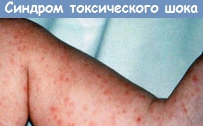 Синдром токсического шока (СТШ). Что это такое, симптомы, как избежать, лечить