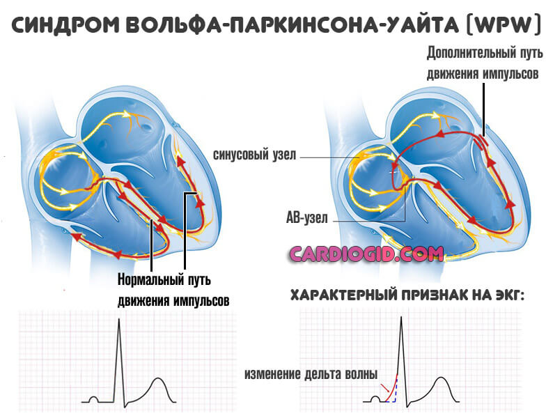 синдром впв